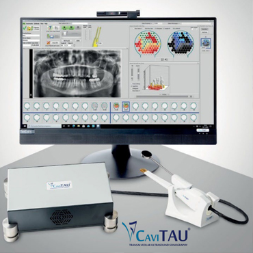 Unsere neueste technische Errungenschaft: das Ultraschall-Gerät CaviTAU®